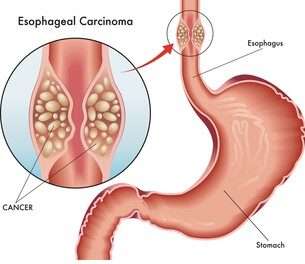 esophageal cancer surgery