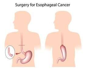 Endoscopic mucosal resection