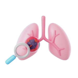 lung cancer