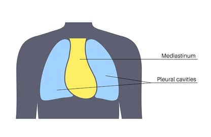 Mediastinal Mass Surgery in Mumbai