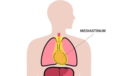 Treatment of Mediastinal Tumors or Mass