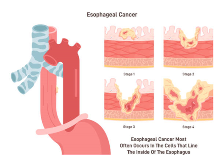 Is esophageal cancer curable?