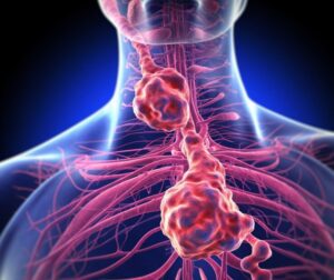 Is Esophageal Cancer Curable?
