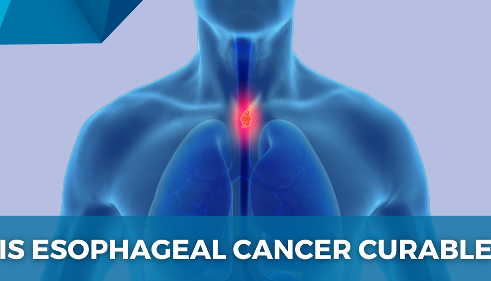 Illustration of human upper body with highlighted esophagus indicating the location of esophageal cancer.