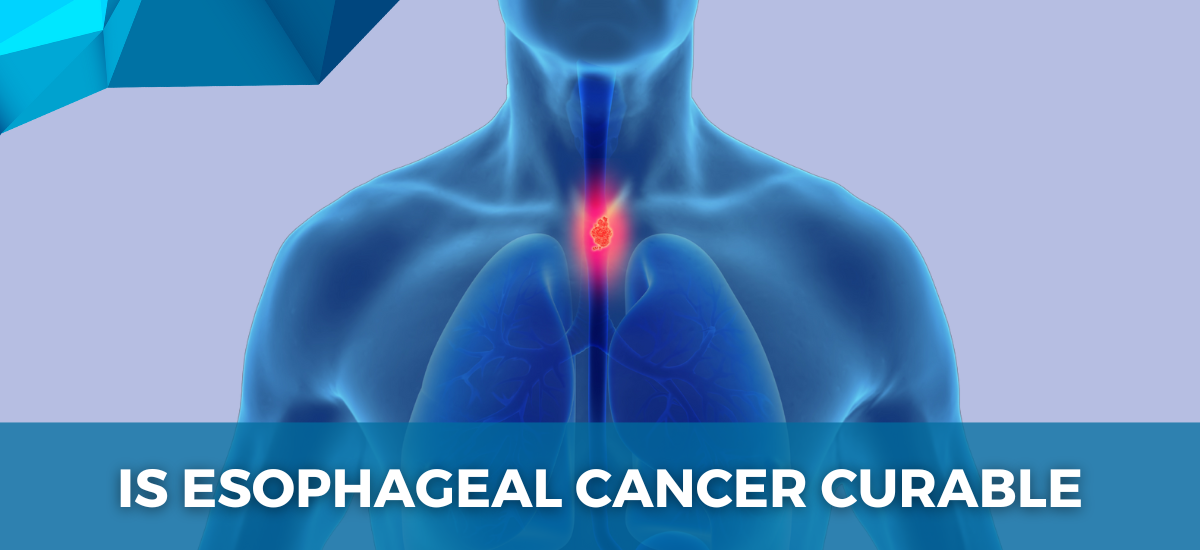 Illustration of human upper body with highlighted esophagus indicating the location of esophageal cancer.