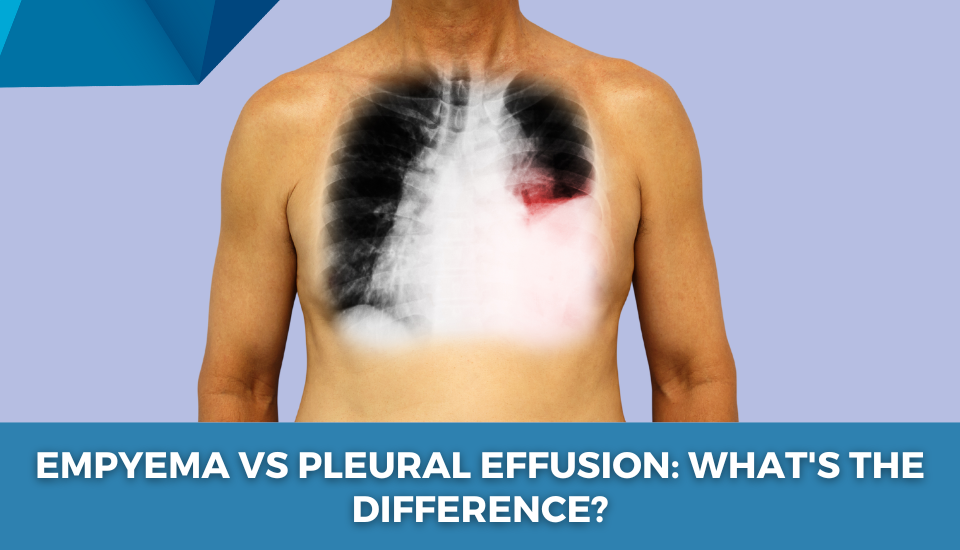 _Empyema_vs_Pleural_Effusion__What_s_the_Difference