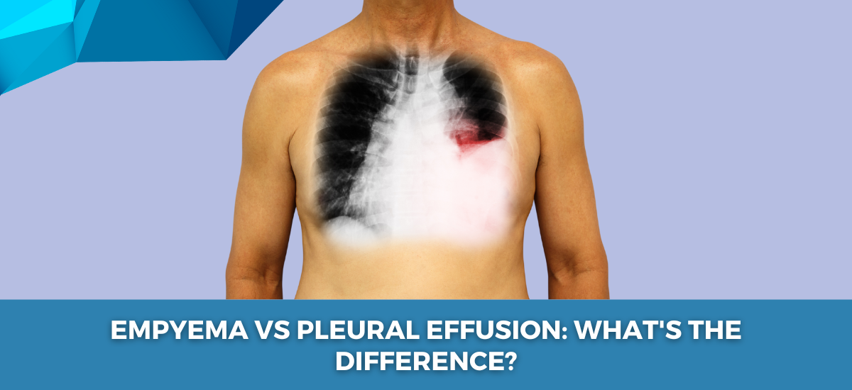 _Empyema_vs_Pleural_Effusion__What_s_the_Difference