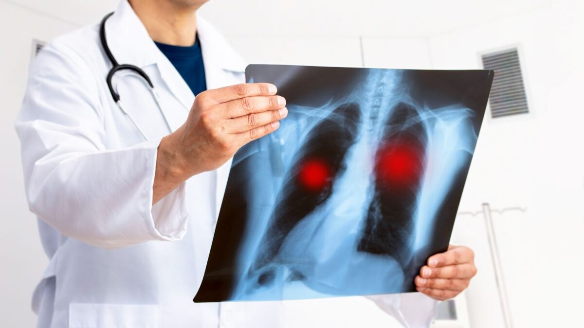 Lung cancer surgery cost in India