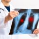 Lung cancer surgery cost in India | George thoracic Lung cancer surgery cost in India