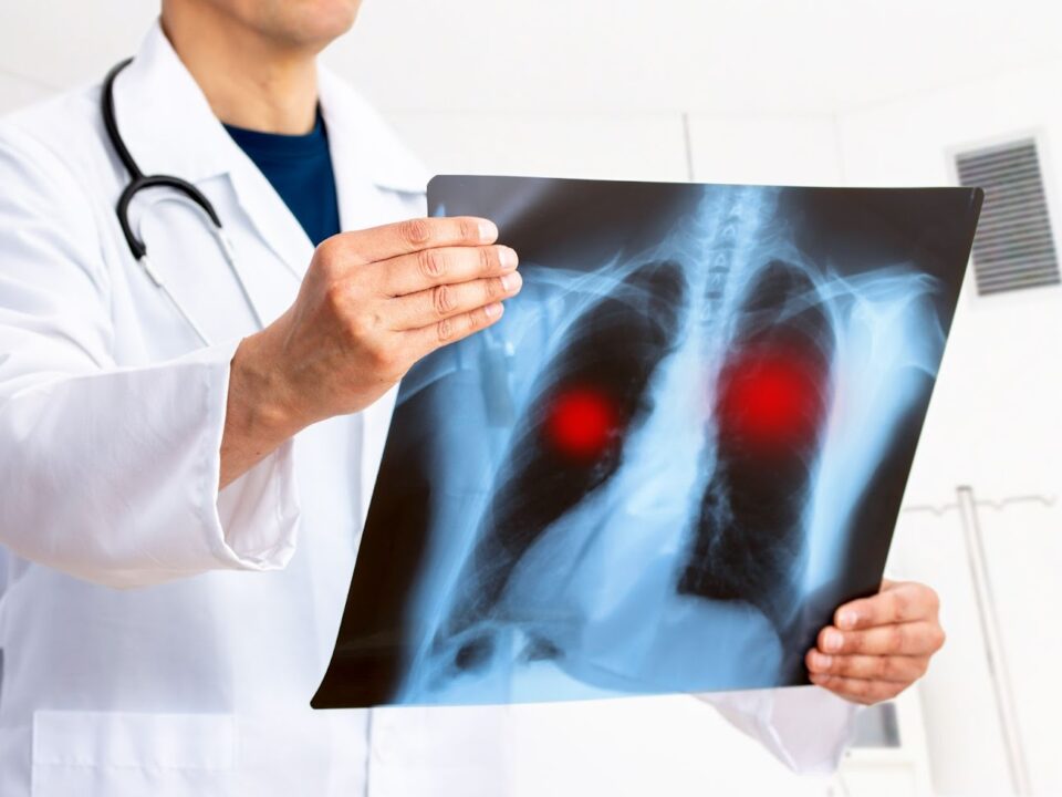 Lung cancer surgery cost in India | George thoracic Lung cancer surgery cost in India