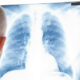 How Is Pleural Effusion Diagnosed and Treated