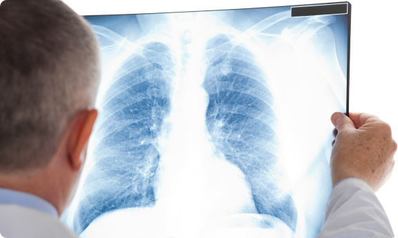 Doctor in a white coat holds a chest X-ray film showing lungs and heart.