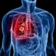 LUNG CANCER FOR SMOKING | George thoracic Lung Cancer Survival Rates by Stage