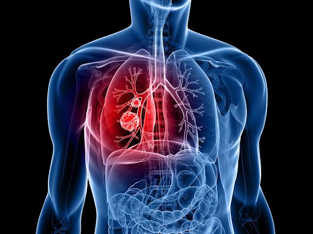 Lung Cancer Survival Rates by Stage