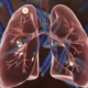 Picture1121 | George thoracic Medical illustration of the lungs showing the bronchial tree and a yellow tumor in the left upper lobe, highlighting a lung mass.