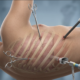 VATS Surgery Recovery Time | George thoracic VATS Surgery Recovery Time