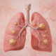 Can You Get Lung Cancer Without Smoking | George thoracic Illustration of human lungs with multiple yellow tumor nodules indicating cancer spread in both lungs.