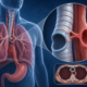 Adult Tracheoesophageal Fistula What Causes It and When Is Surgery Needed | George thoracic Adult Tracheoesophageal Fistula What Causes It and When Is Surgery Needed