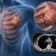 Chest Wall Tumors When Is Surgery Needed | George thoracic Chest Wall Tumors When Is Surgery Needed