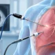 VATS Lung Biopsy How the Procedure Works