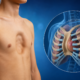 What Is Pectus Excavatum and How Is It Fixed