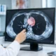 What Is a Mediastinal Cyst and Does It Need Surgery