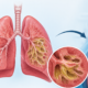 Bronchiectasis Surgery When Is It an Option