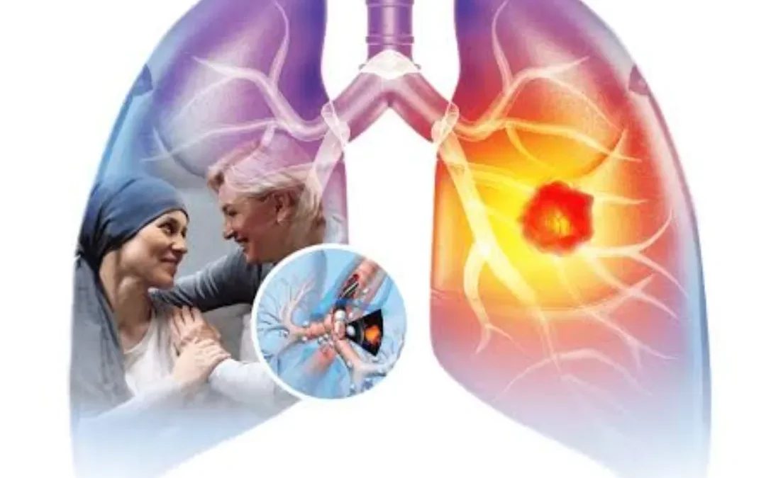 Colorful diagram of human lungs showing a tumor in the right lung; inset depicts a doctor-patient consultation or examination.
