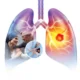 Lung Cancer Screening | George thoracic Colorful diagram of human lungs showing a tumor in the right lung; inset depicts a doctor-patient consultation or examination.