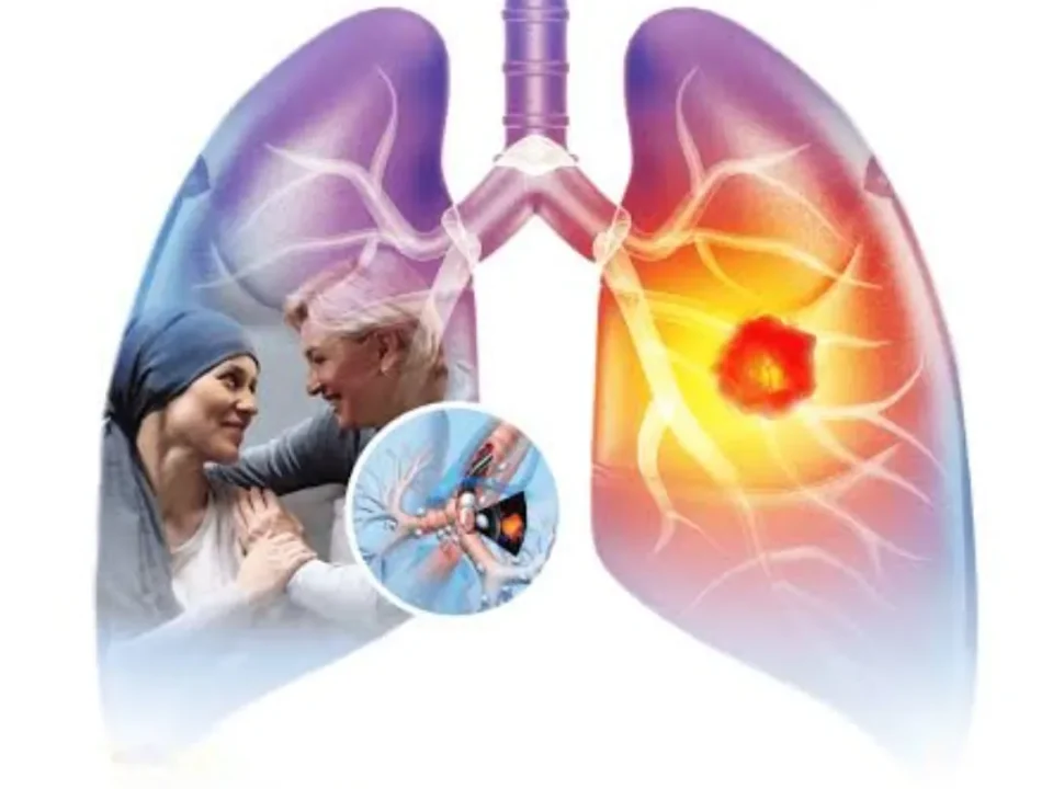 Colorful diagram of human lungs showing a tumor in the right lung; inset depicts a doctor-patient consultation or examination.
