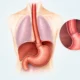 Minimally Invasive Esophagectomy What to Expect | George thoracic Minimally Invasive Esophagectomy What to Expect