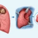 Aspergilloma Surgery Who Needs It and Why