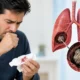 Coughing Up Blood Could It Be Aspergilloma
