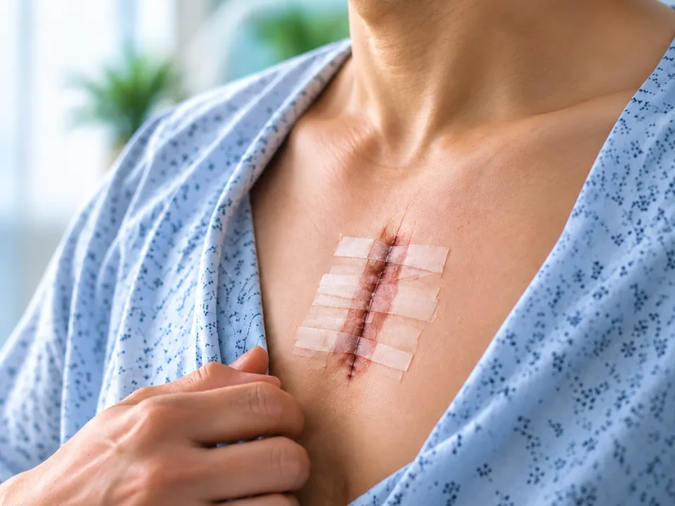 Person in a hospital gown lifting the shirt to reveal a healing vertical chest incision secured with multiple adhesive bandages.