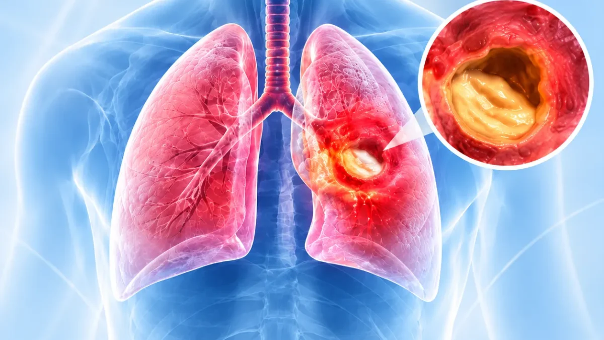 Medical illustration of the lungs with a right bronchial tumor; inset shows a cross-section of the airway with tumor.