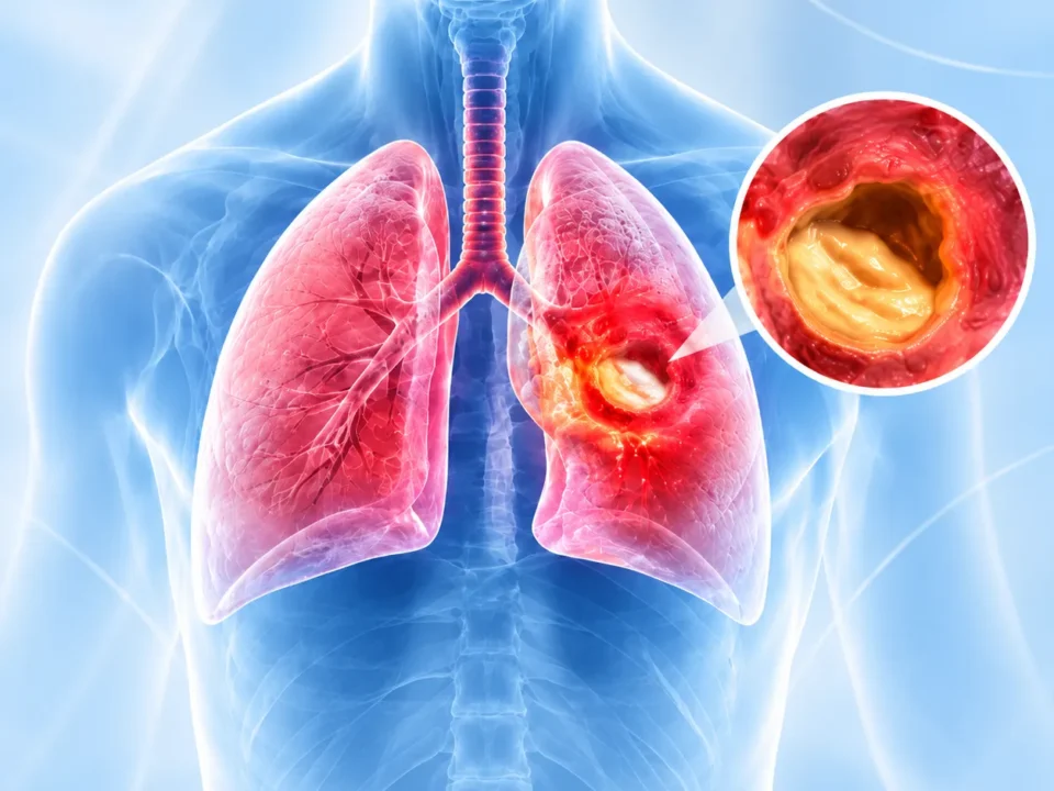 Medical illustration of the lungs with a right bronchial tumor; inset shows a cross-section of the airway with tumor.